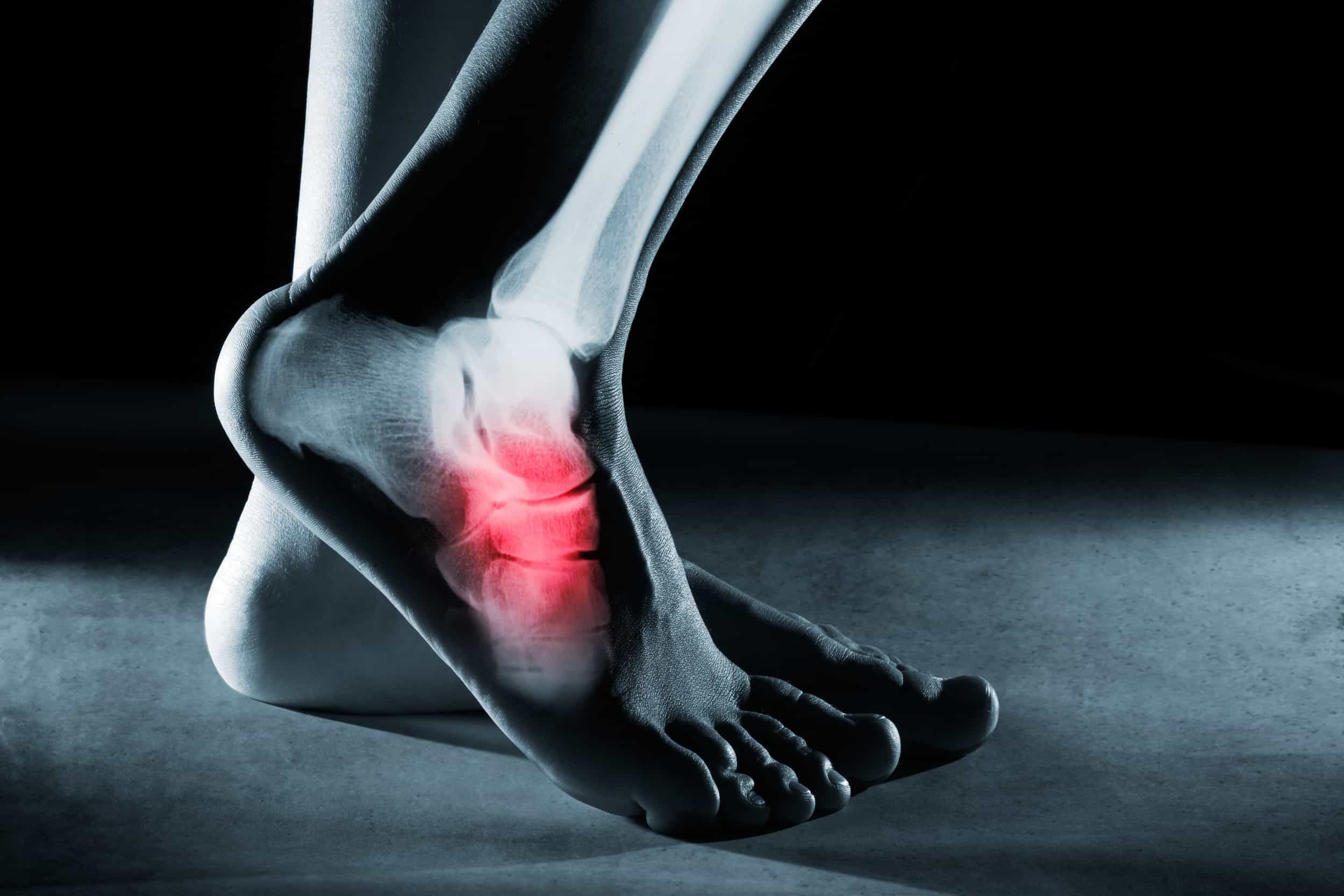 Unraveling the Mystery of Stress Fractures on Top of the Foot